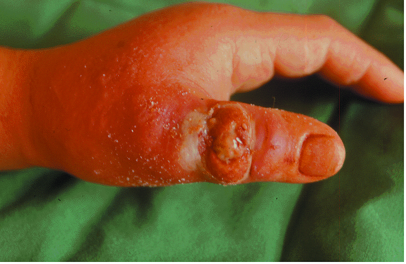 Próby stosowania propolisu w leczeniu ran, oparzeń i odleżyn